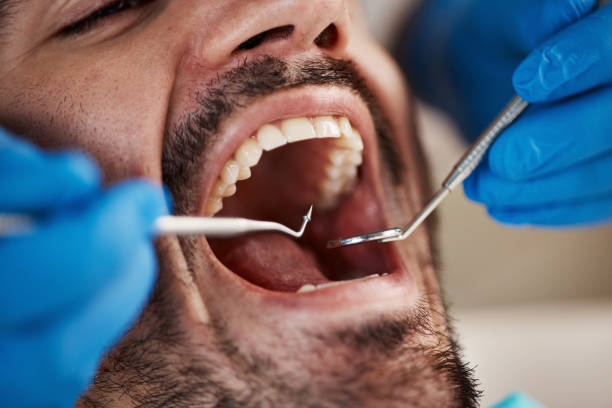 Best Emergency Dentist for Lost Fillings or Crowns in Millville, DE